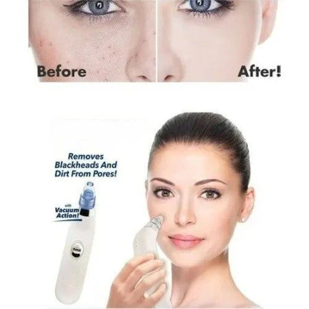 4 in 1 Vacuum Pore Cleaning Device - Image 6